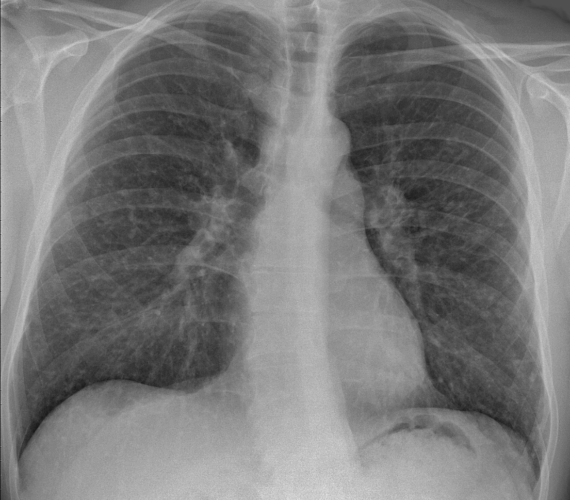 Syndroom Van Sarcoïdose - Deel 3