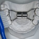 Chelsey’s ervaring met een Hyrax beugel