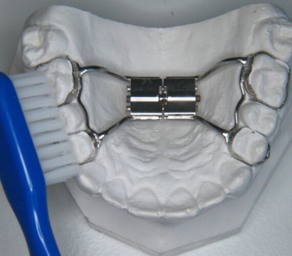 Chelsey’s ervaring met een Hyrax beugel