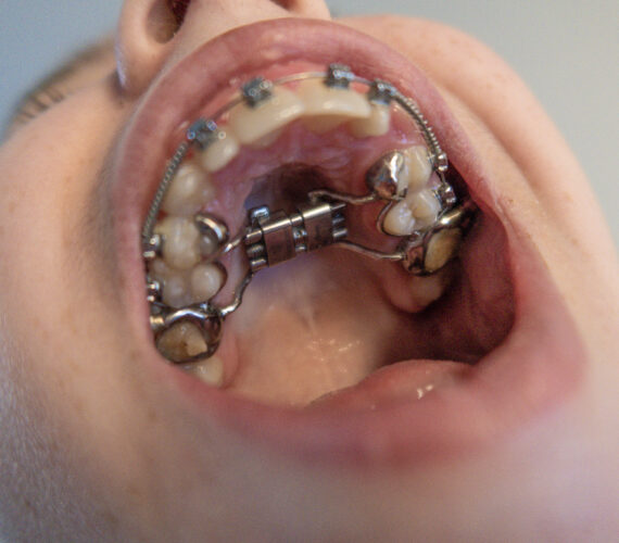 Chelsey’s ervaring met een Hyrax beugel