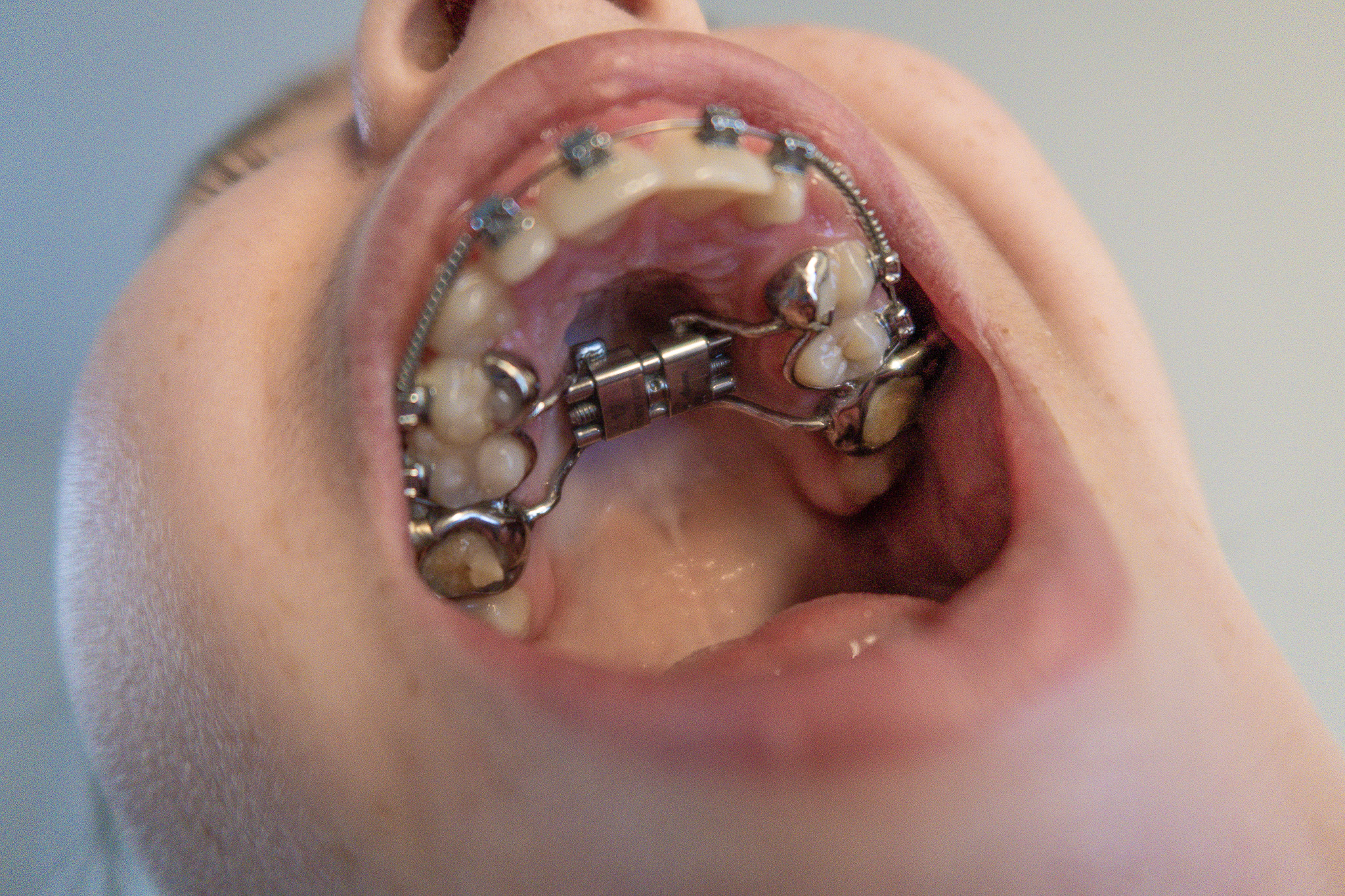 Chelsey’s ervaring met een Hyrax beugel