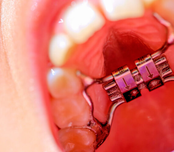 Chelsey’s ervaring met een Hyrax beugel